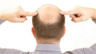 Cure contre la perte de cheveux (Alopécie)